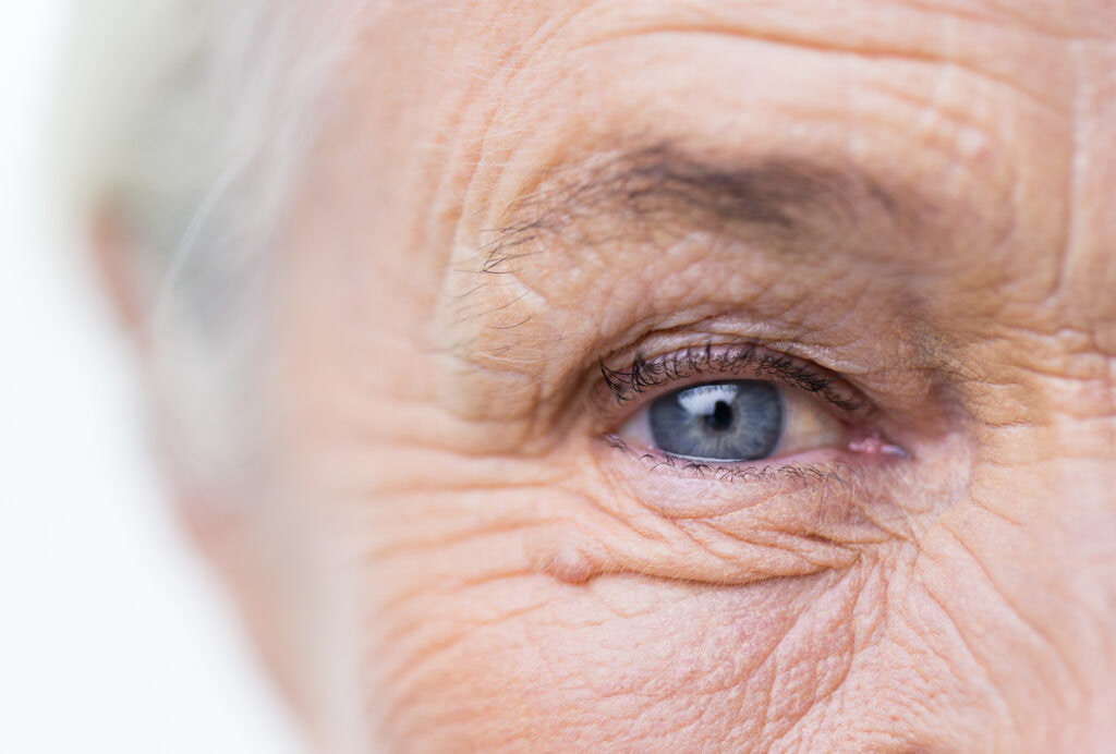 Close-up of eye suffering from wet age-related macular degeneration.