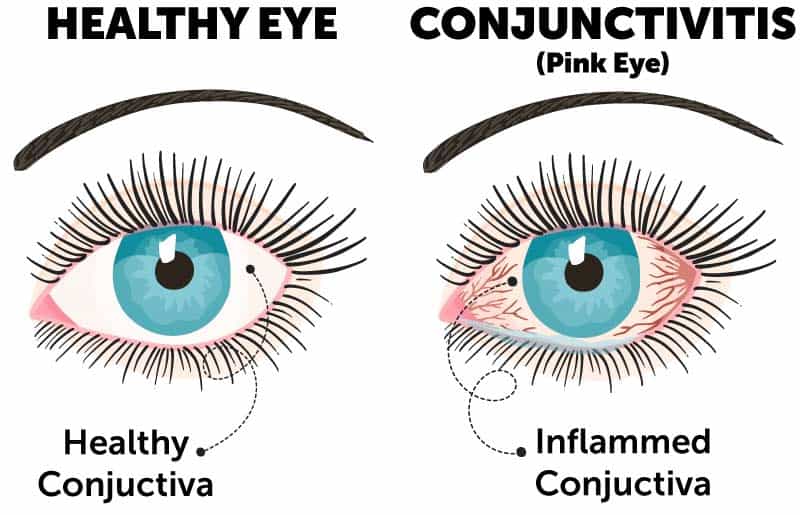 Pink eye diagram comparing healthy eye and eye with pink eye and inflamed conjunctiva (conjunctivitis).