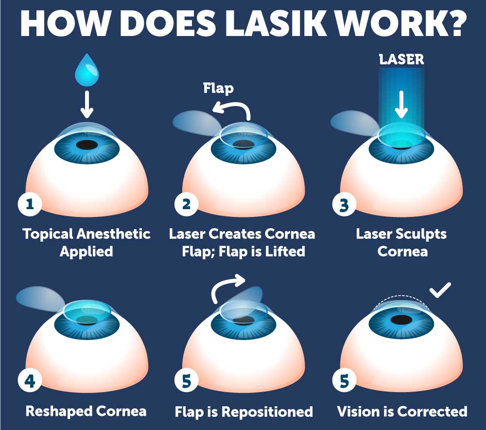Step-by-step diagram of how LASIK works at Wolfe Eye Clinic.