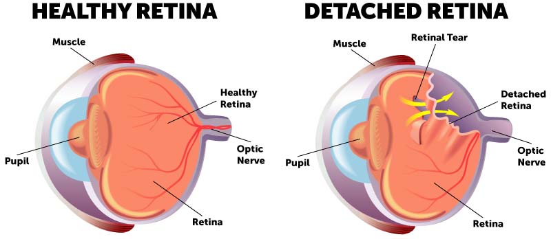 Detached retina diagram comparing a healthy retina to an eye with a retinal tear and retinal detachment. 