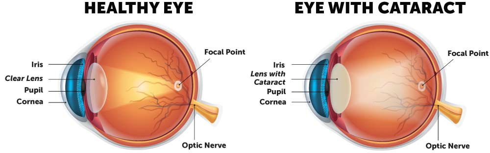 eye cataract without