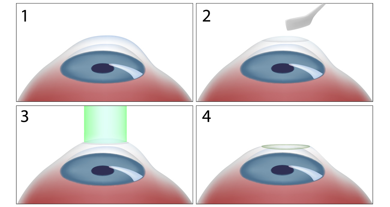 An image showing the steps of the PRK procedure on an eye