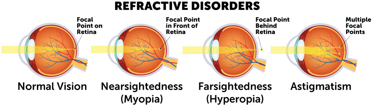 the vision disorder due to a misshapen cornea is