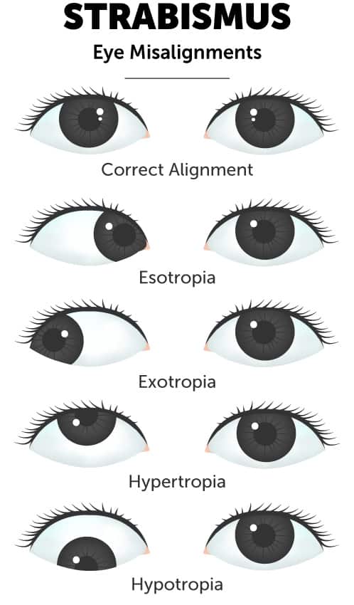Syndrome wandering eye Amblyopia or