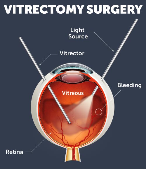 retina surgery recovery products
